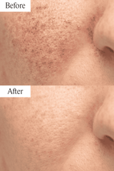 Rosacea Bundle