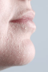 Dry Skin