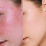 Post Treatment Bundle