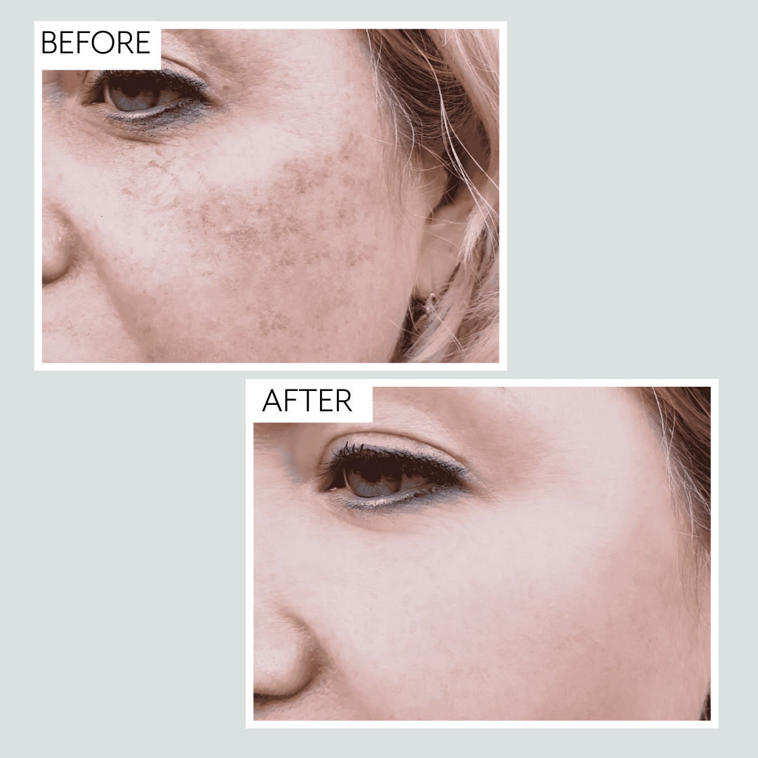 Hyperpigmentation Bundle