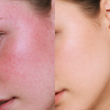 Post Treatment Bundle