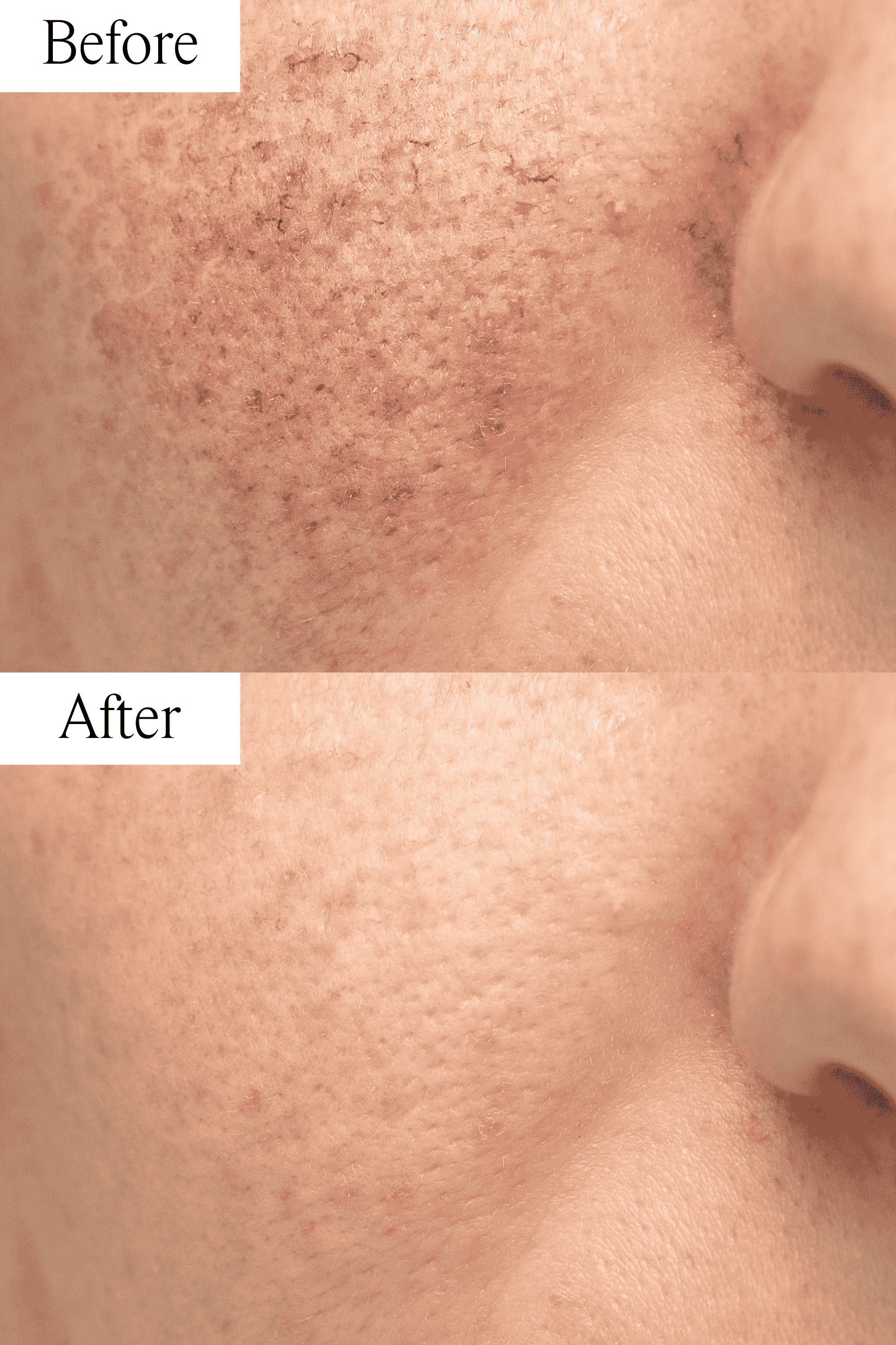 Rosacea Bundle